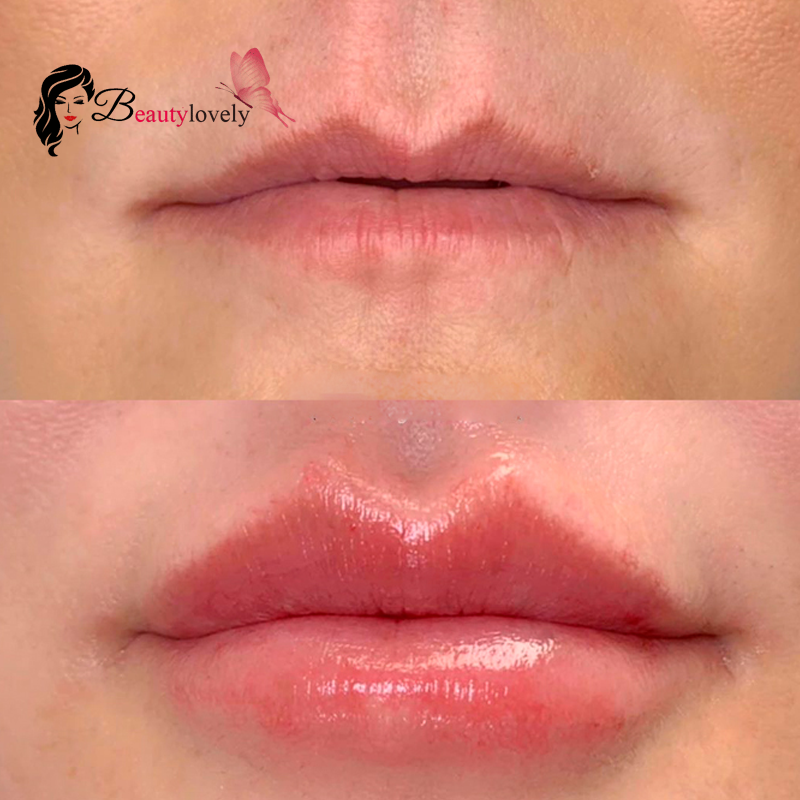 مزایای ژل لب استایلج فرانسه مدل L