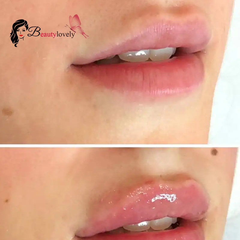 کاربرد فیلر فرانسوی استایلج M