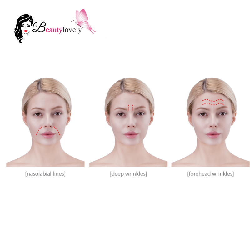 ویژگی های نخ لیفت و جواسنسازی مش